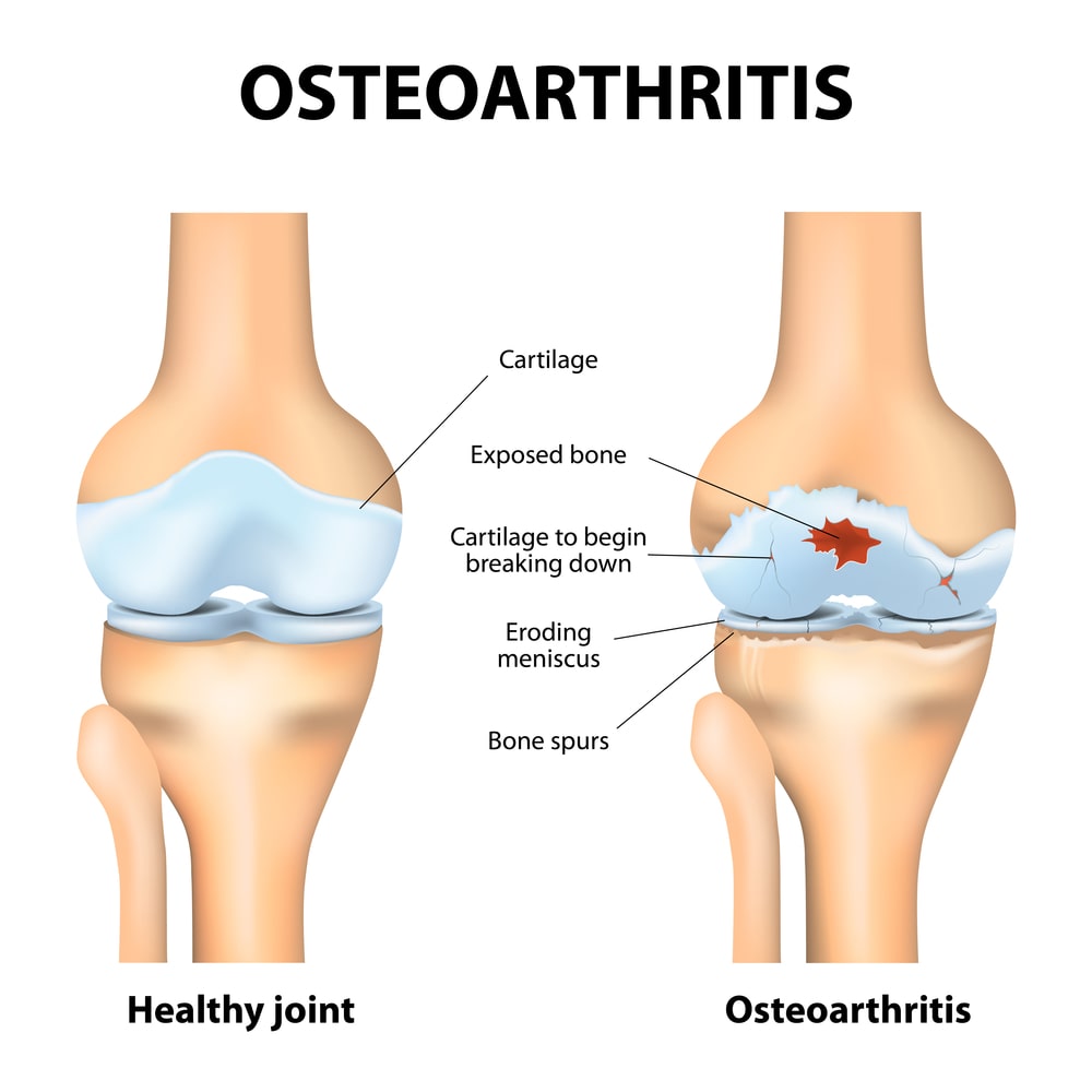 osteoarthritis or arthritis