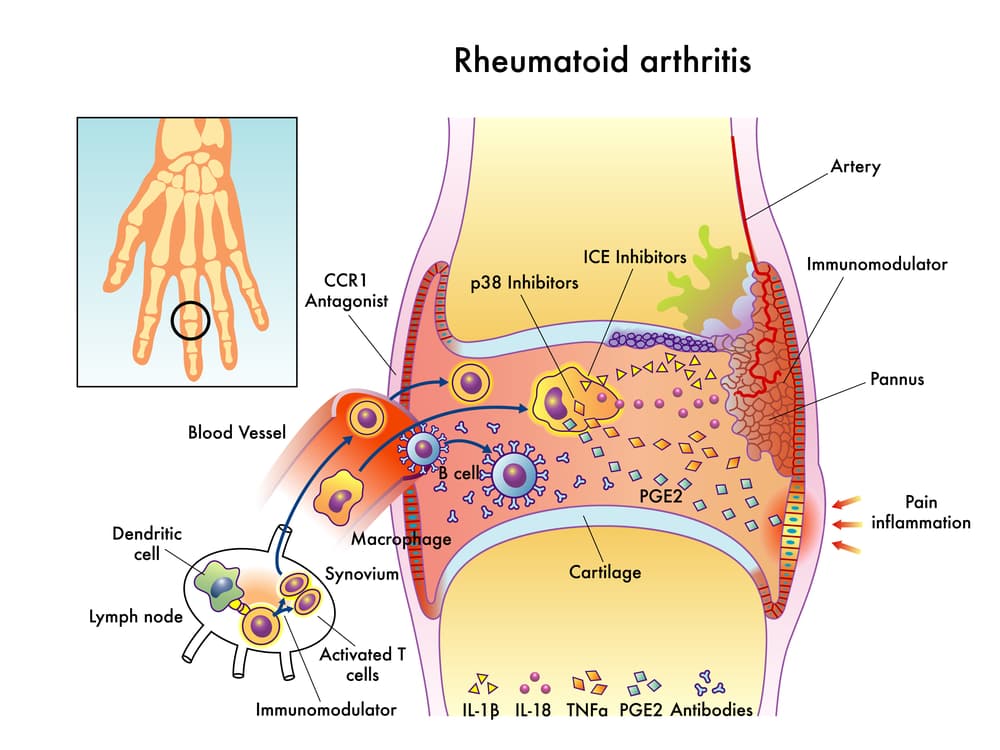 Cbd For Rheumatoid Arthritis Explaining The Science
